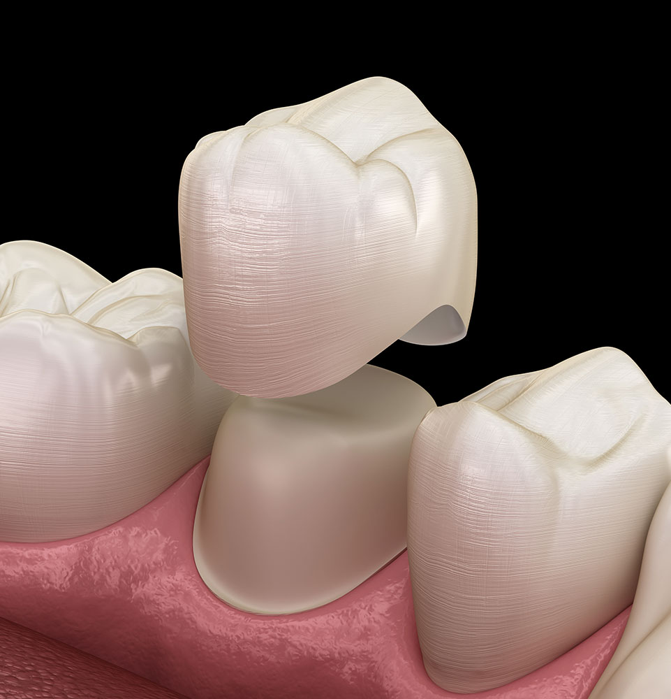 dental crown