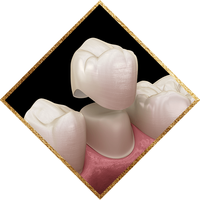 dental crown 5050