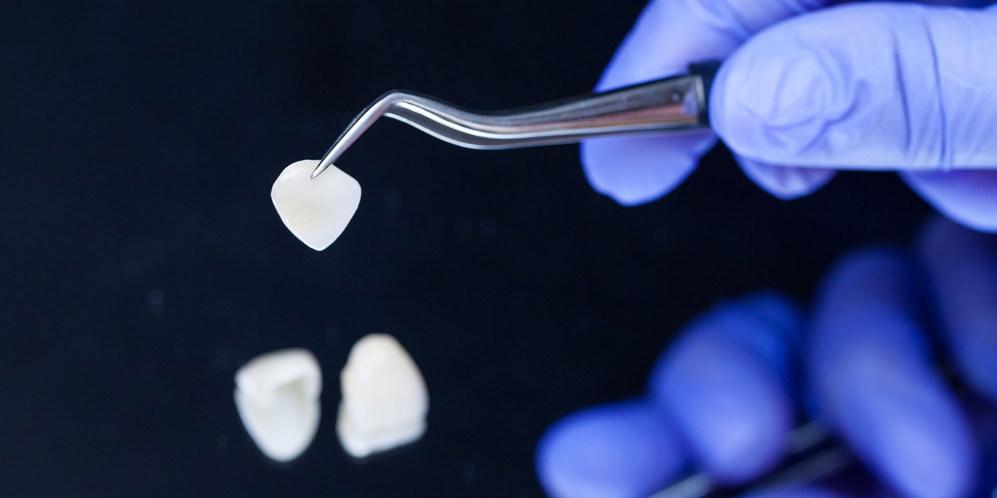 handcrafted porcelain veneers