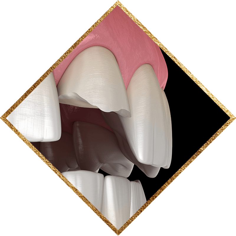 tooth chip from teeth